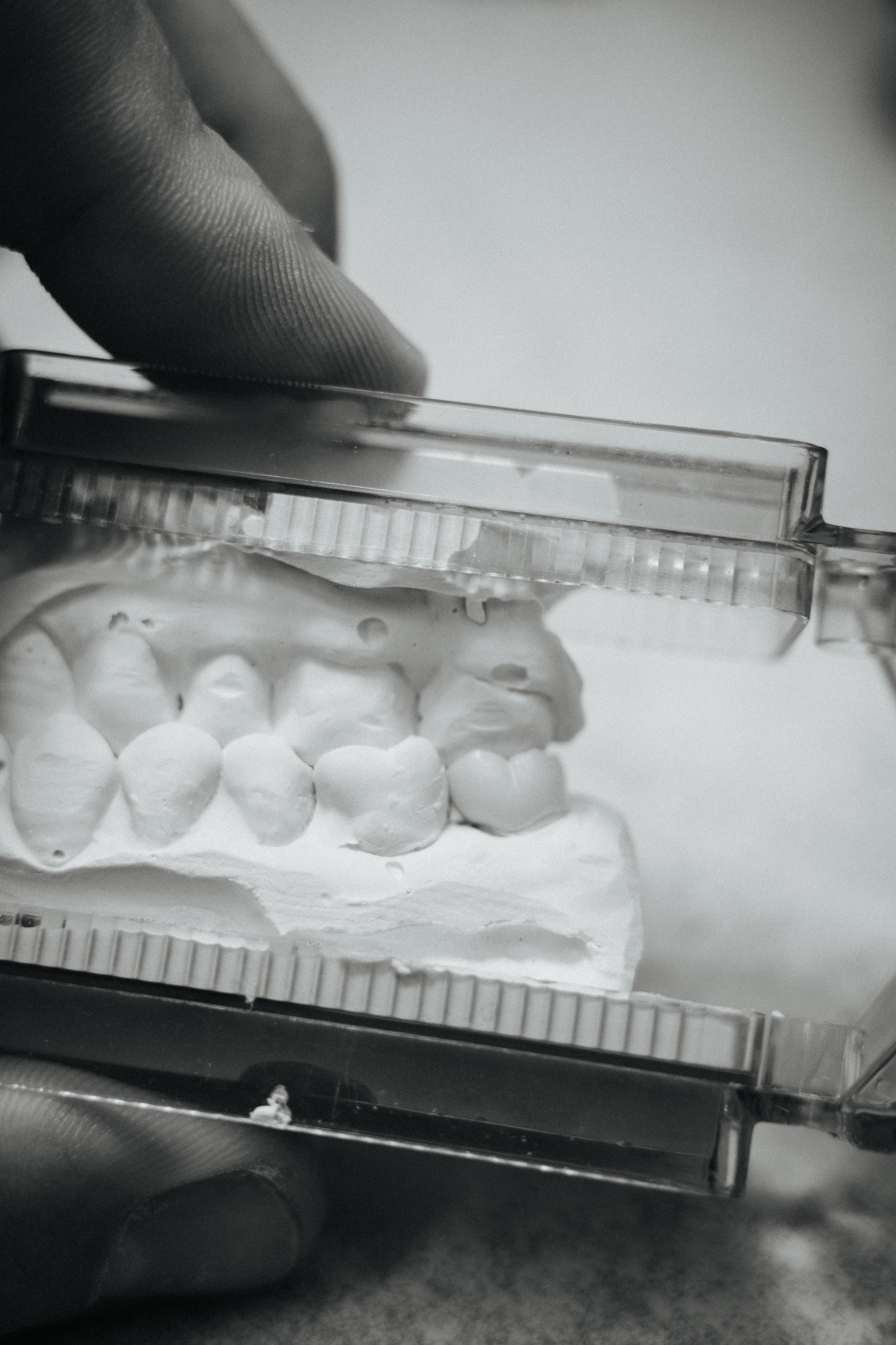 Custom titanium abutment on articulator