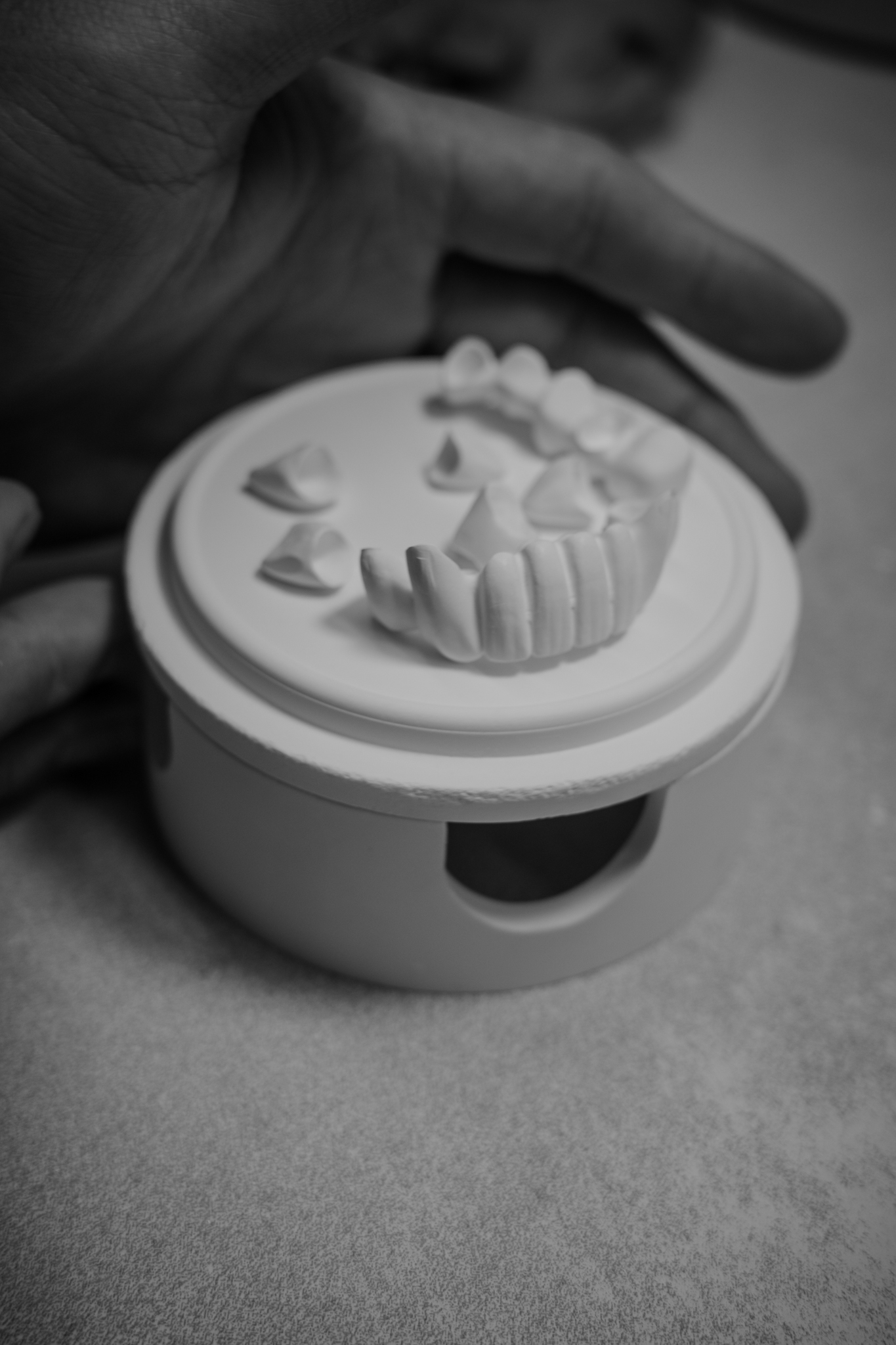 Implant crown on pindex working model