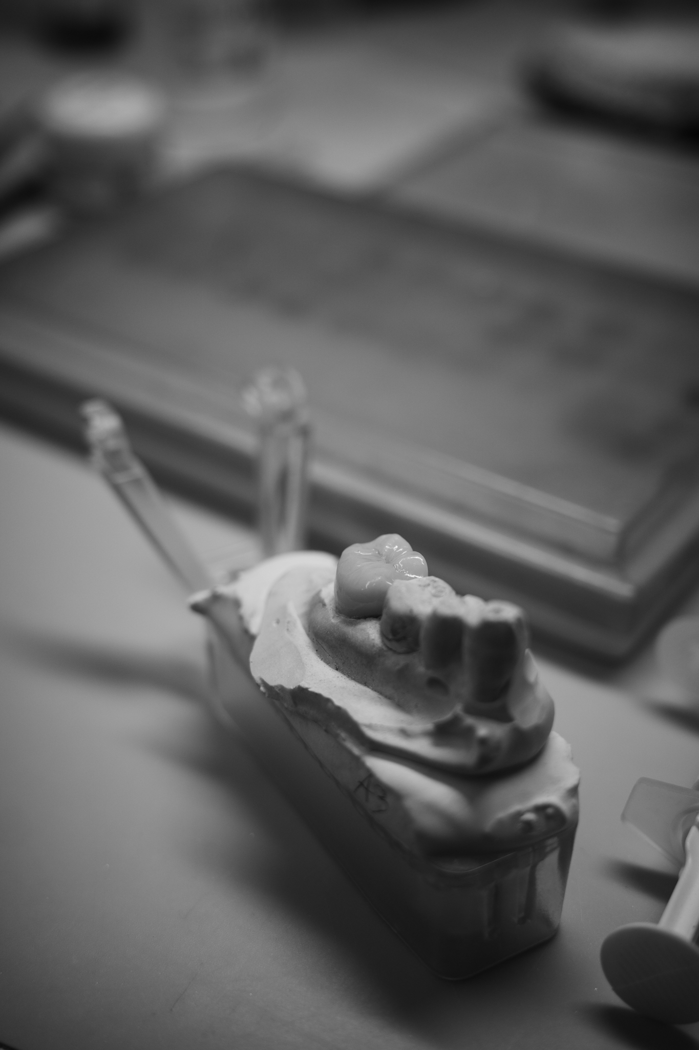 Layered E.max crown on sectioned die