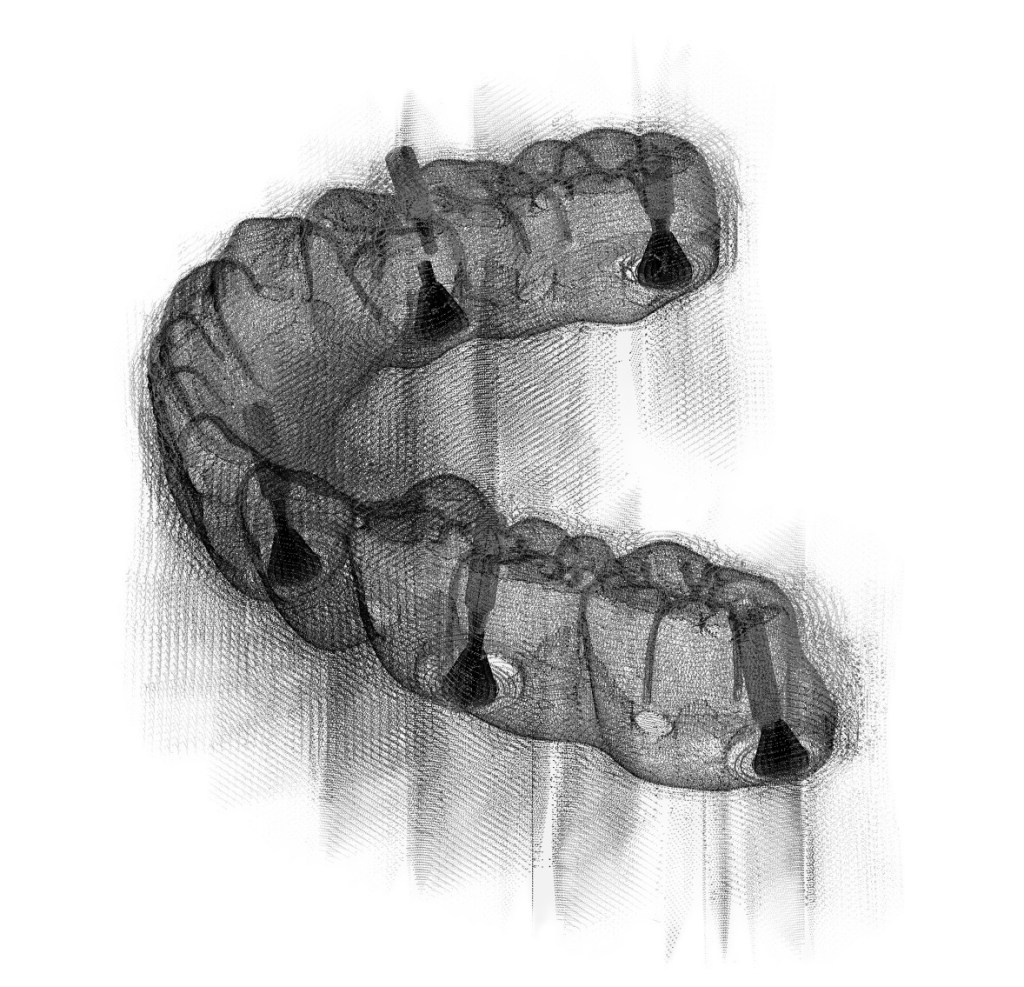 Milled Titanium Implant Bar